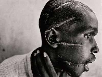 A-survivor-of-a-vicious-machete-attack-which-were-characteristic-of-the-Rwandan-Genocide.-BBC.jpg
